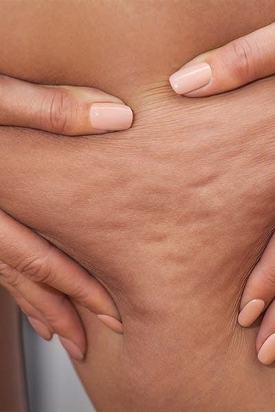 як прибрати целюліт
