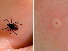 перші симптоми хвороби Лайма